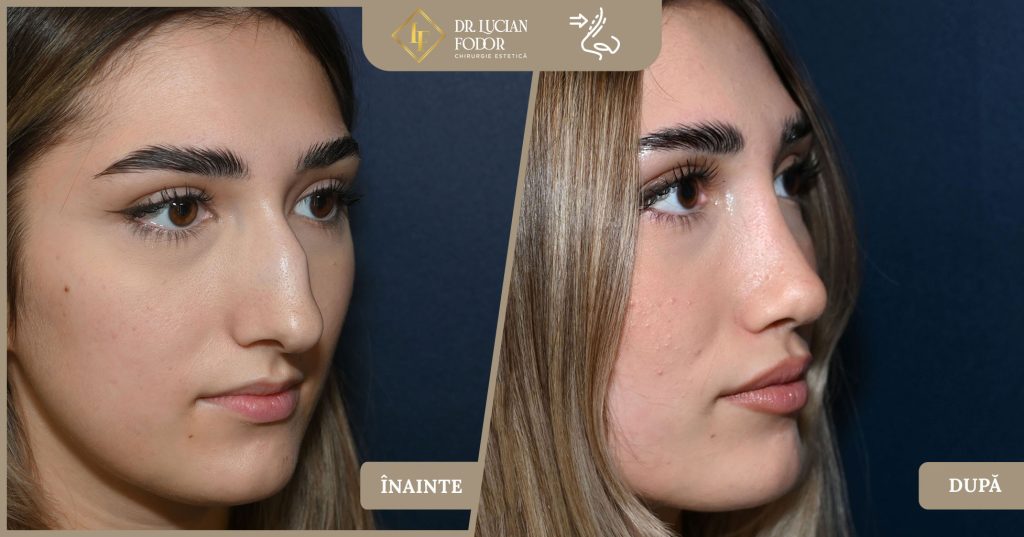 Rinoplastie - Operație nas, Caz 266 Foto 3