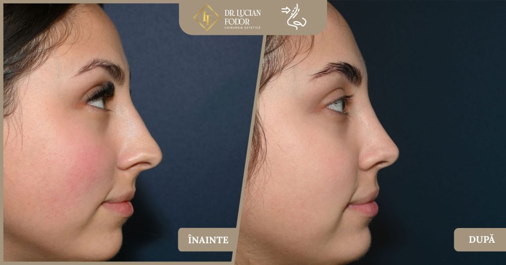 Rinoplastie vârf nazal, rafinament chirurgical -  Caz 267 Foto 1
