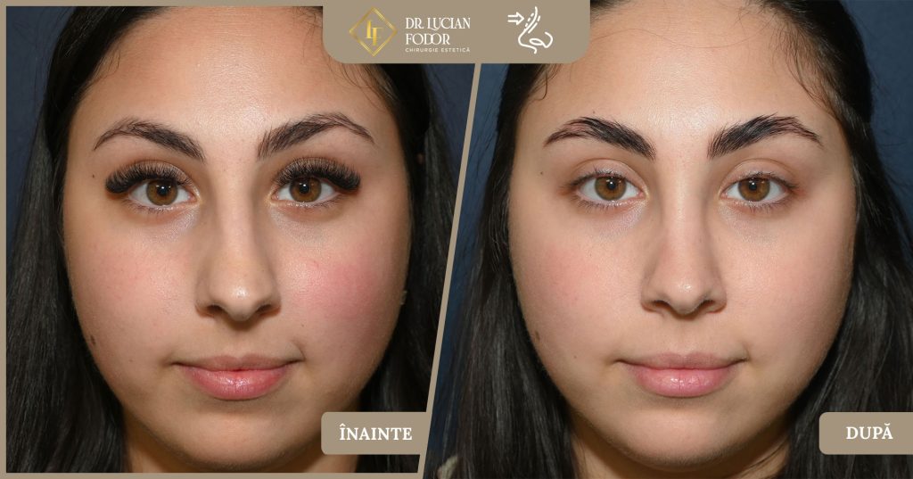 Rinoplastie vârf nazal, rafinament chirurgical  -  Caz 267 Foto 2