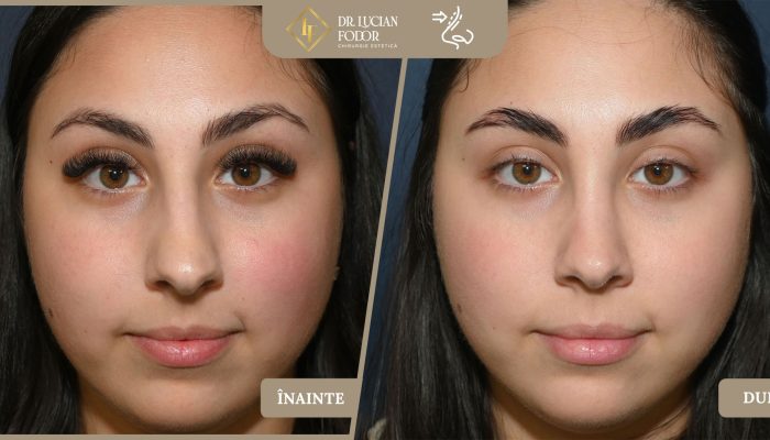 Rinoplastie de rafinament — Vârf nazal mărit și disproporțional – Caz 267