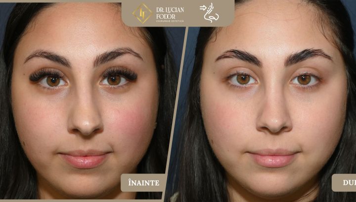 Rinoplastie de rafinament — Vârf nazal mărit și disproporțional – Caz 267