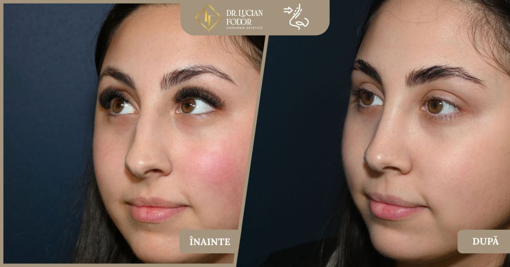 Rinoplastie vârf nazal, rafinament chirurgical  -  Caz 267 Foto 3