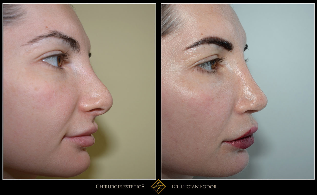 Rinoplastie / septoplastie, Caz 240 Foto 1