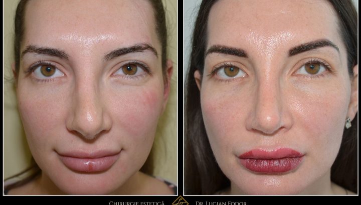 Caz 240 – Rinoplastie secundară