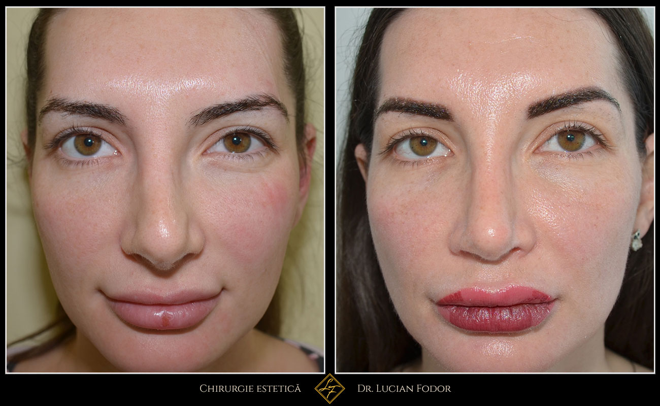 Rinoplastie / septoplastie, Caz 240 Foto 2