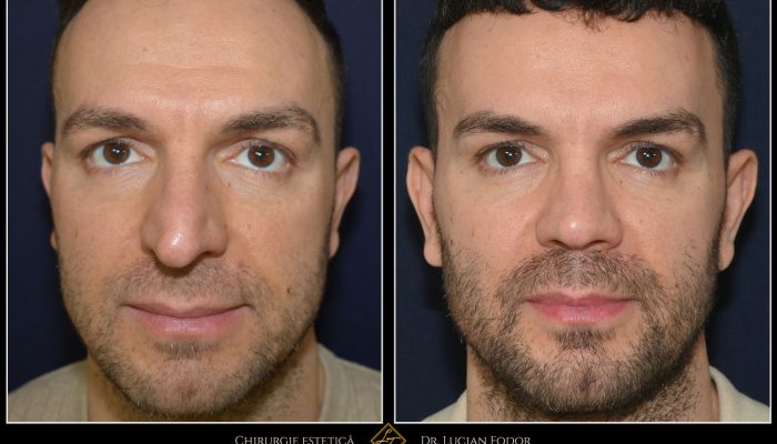 Caz 241 – Rinoplastie bărbați – dublă deviație de sept