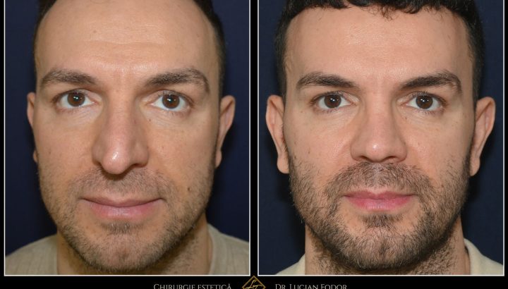 Caz 241 – Rinoplastie bărbați – dublă deviație de sept