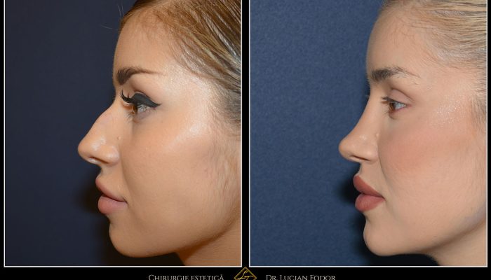 Case 245 – Rhinoplasty