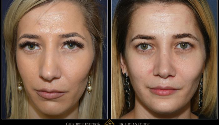 Case 255 – Rhinoplasty with chin implants