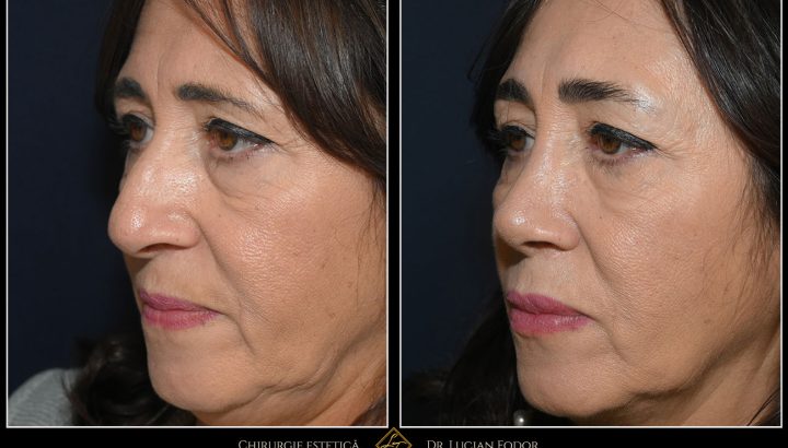 Rinoseptoplastie prin abord închis – corecție estetică și funcțională fără cicatrici vizibile – Caz 257
