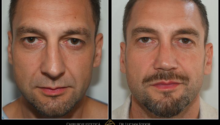 Rinoseptoplastie închisă cu grefe de cartilaj – corecție funcțională și estetică pentru pacient masculin