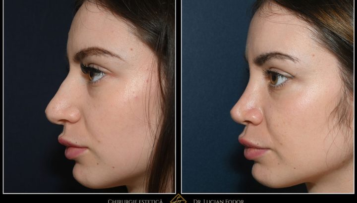 Rhinoseptoplasty – complete reshaping of the nose for aesthetic harmony and functional breathing