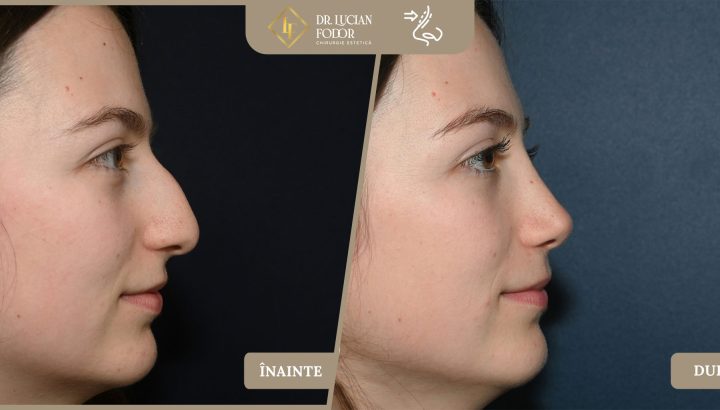 Rinoplastie închisă de micșorare — Nas mărit disproporționat, lat, cu cocoașă și vârf coborât – Caz 269