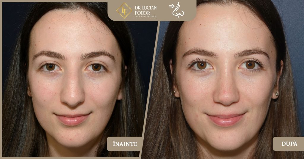 Rinoplastie nas lat - Foto 3
