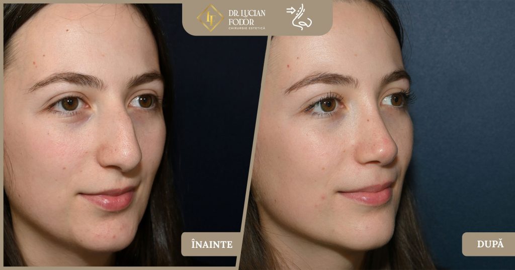 Rinoplastie nas lat - Foto 2