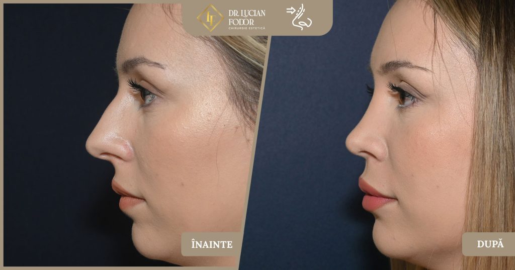 Rinoplastie nas lat - Foto 1